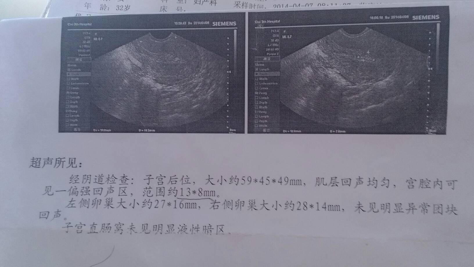 看到孕囊组织排除,目前的b超检查结果考虑是宫腔内少许残留的蜕膜组织