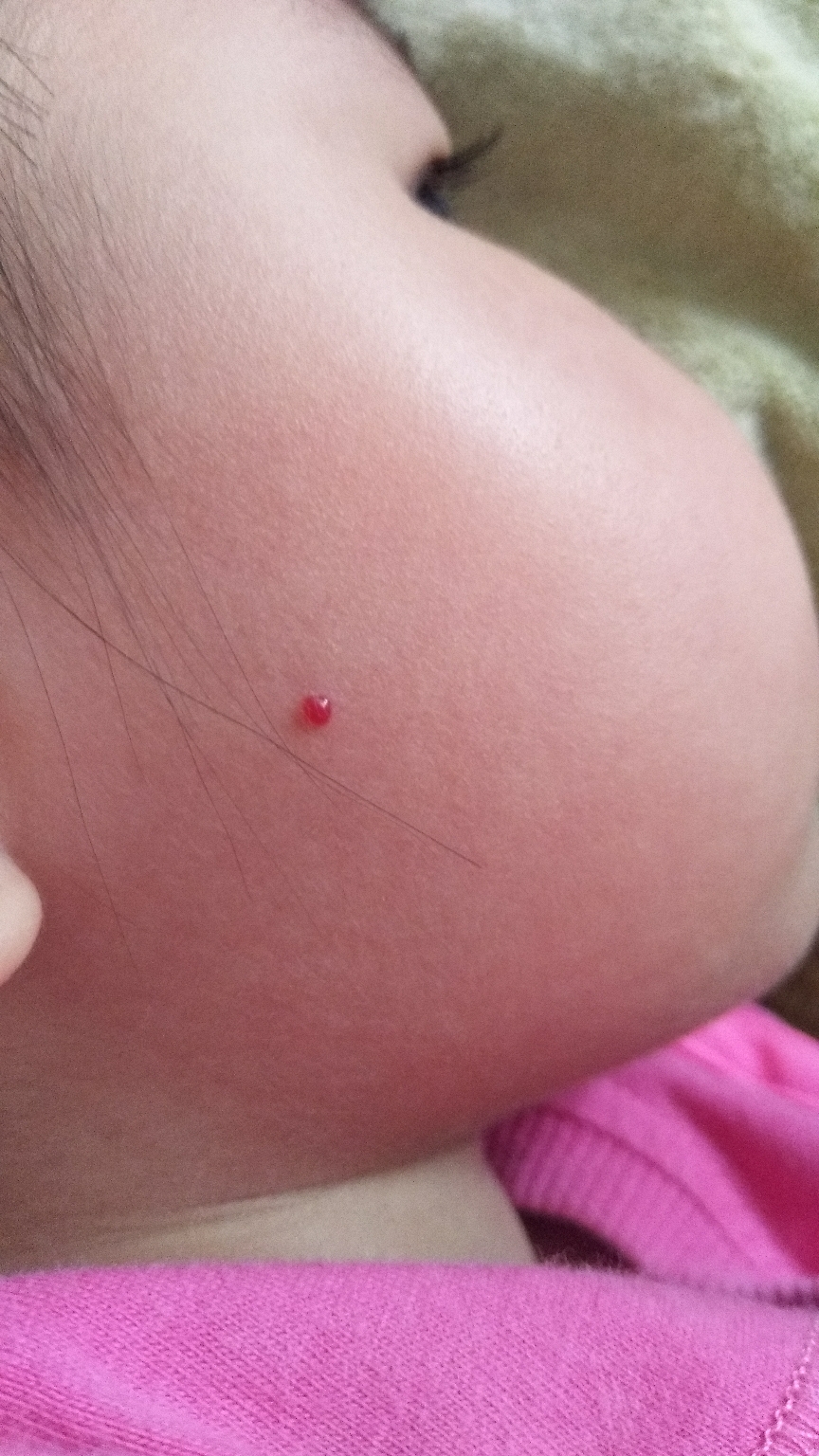 我家宝宝三岁,脸上突然发现一个血点包,人说是血管痣