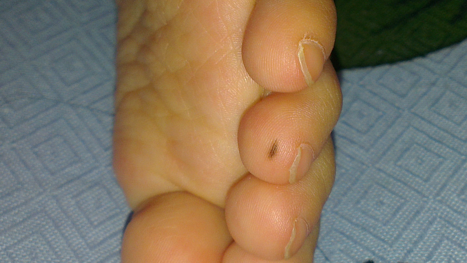18个月的宝宝脚趾肚上长了块黑色的,而且好像这几天看