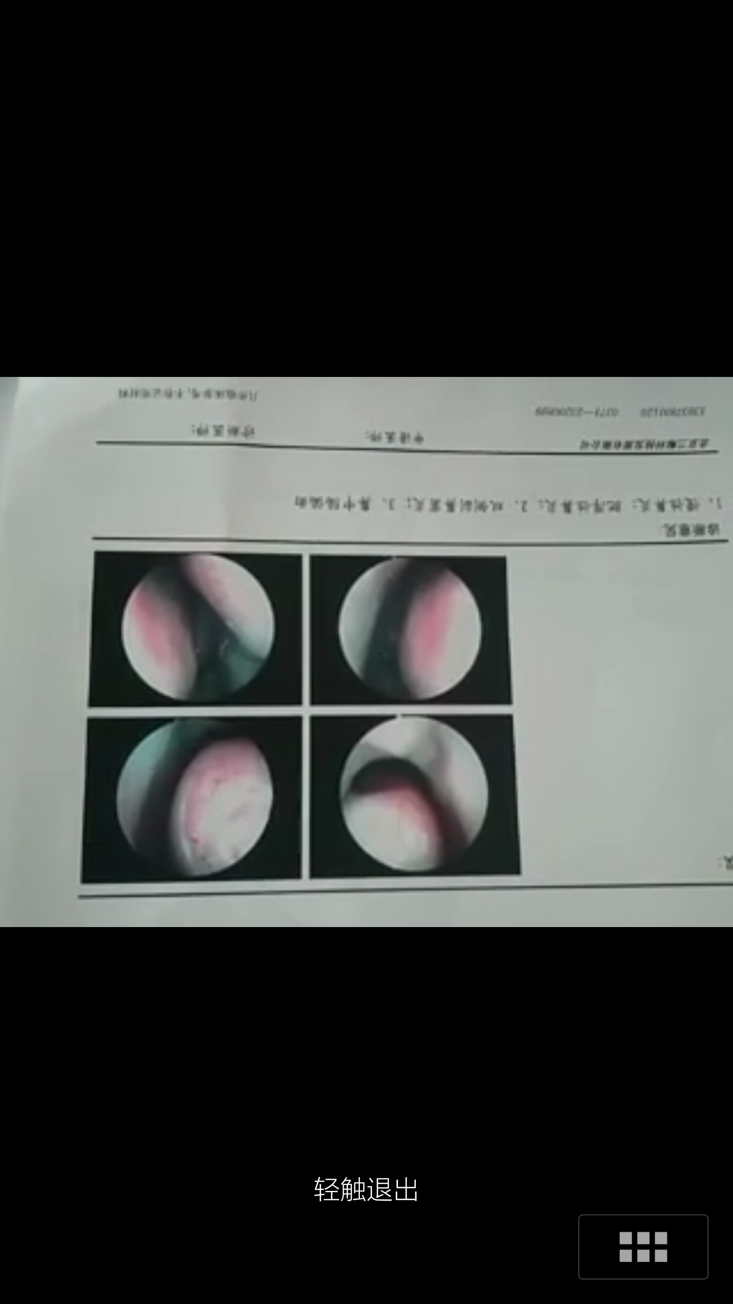 穿刺能解决鼻甲水肿吗?那