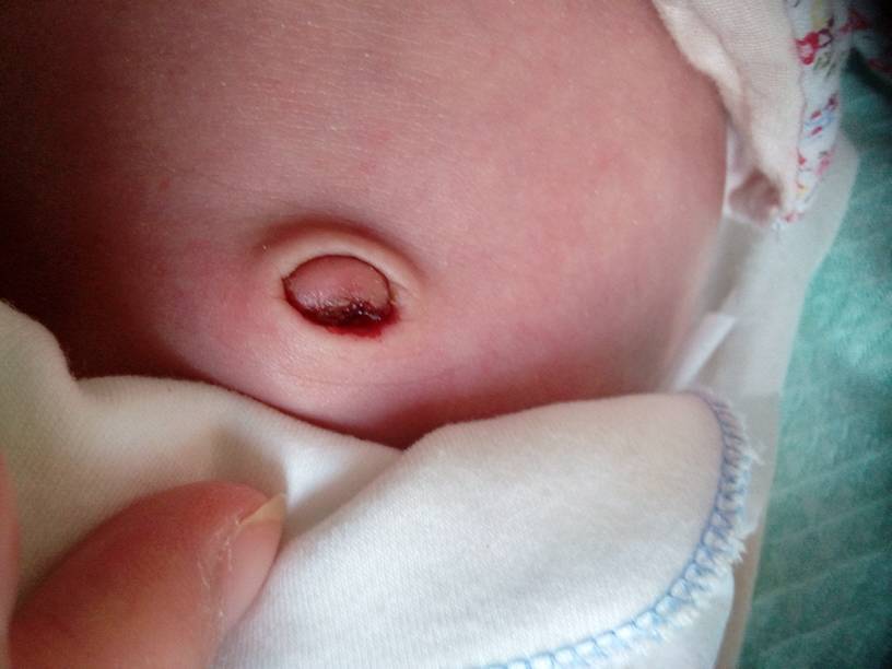 宝宝出生后13天肚脐掉了,但是还有一层结痂的硬壳在上面,昨天下午结痂
