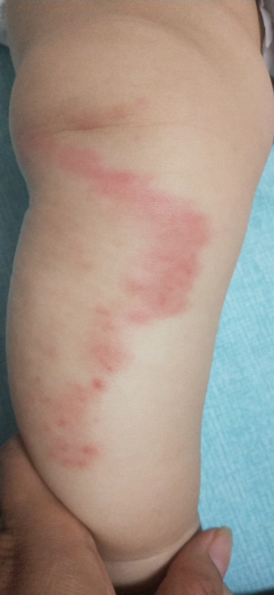 七个月婴儿小腿过敏性湿疹已经一个月了,一直往外扩散现在都到大腿了