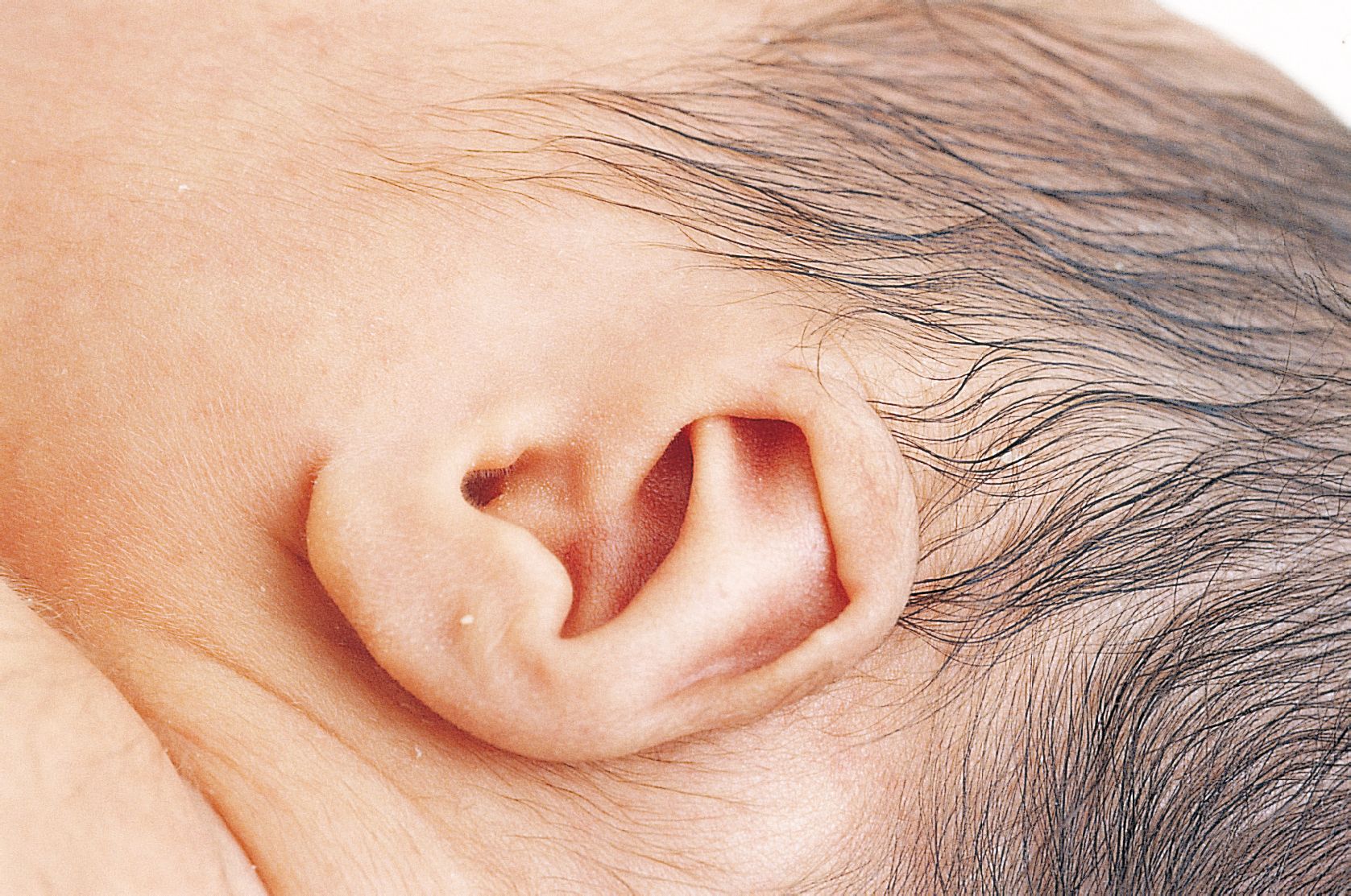 精灵耳、招风耳……新生儿耳廓畸形，矫正要趁早