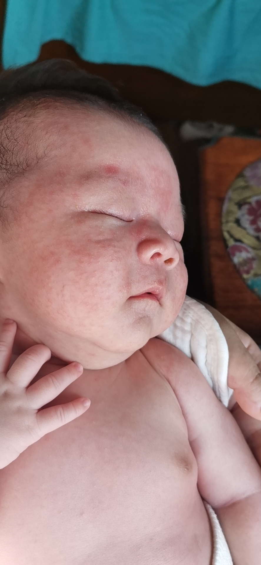 我家宝宝26天,脸上长满米粒大小的红疙瘩,有白顶,有说