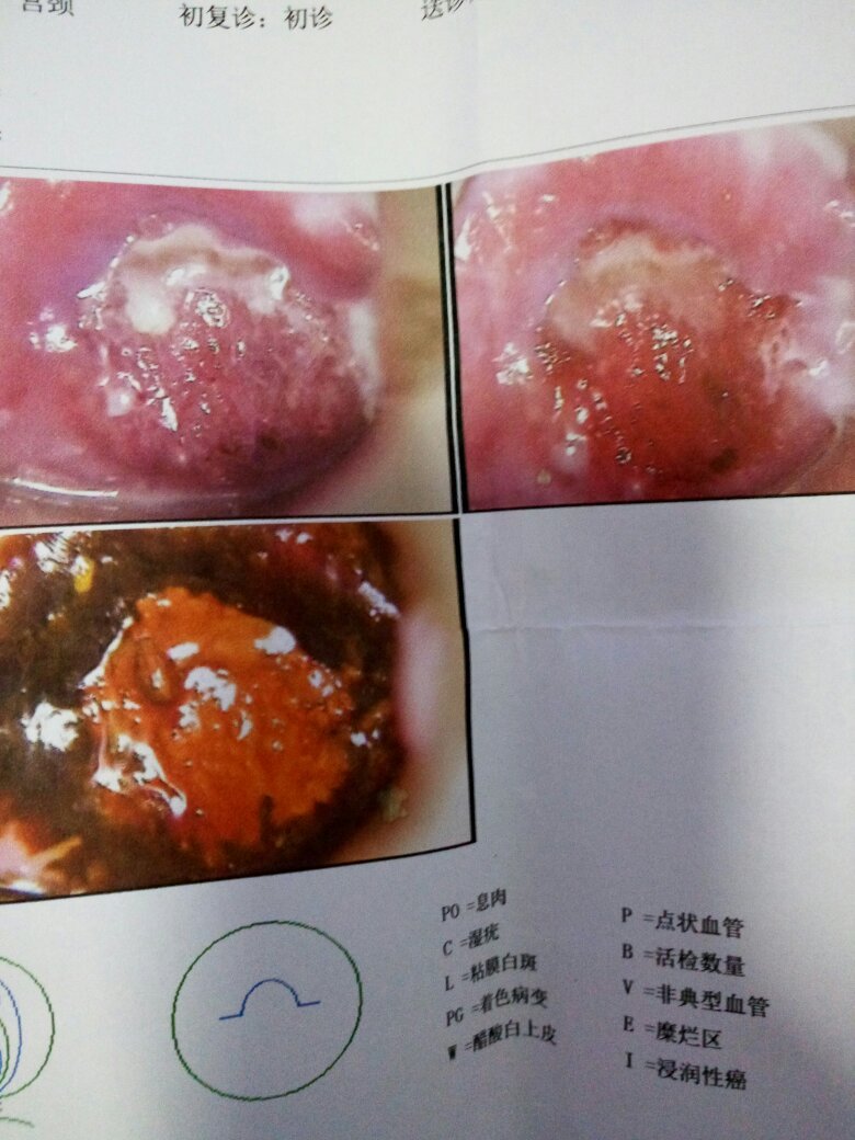 今年21岁,去医院检查说是有宫颈糜烂还有点严重建议动手术说怕以后