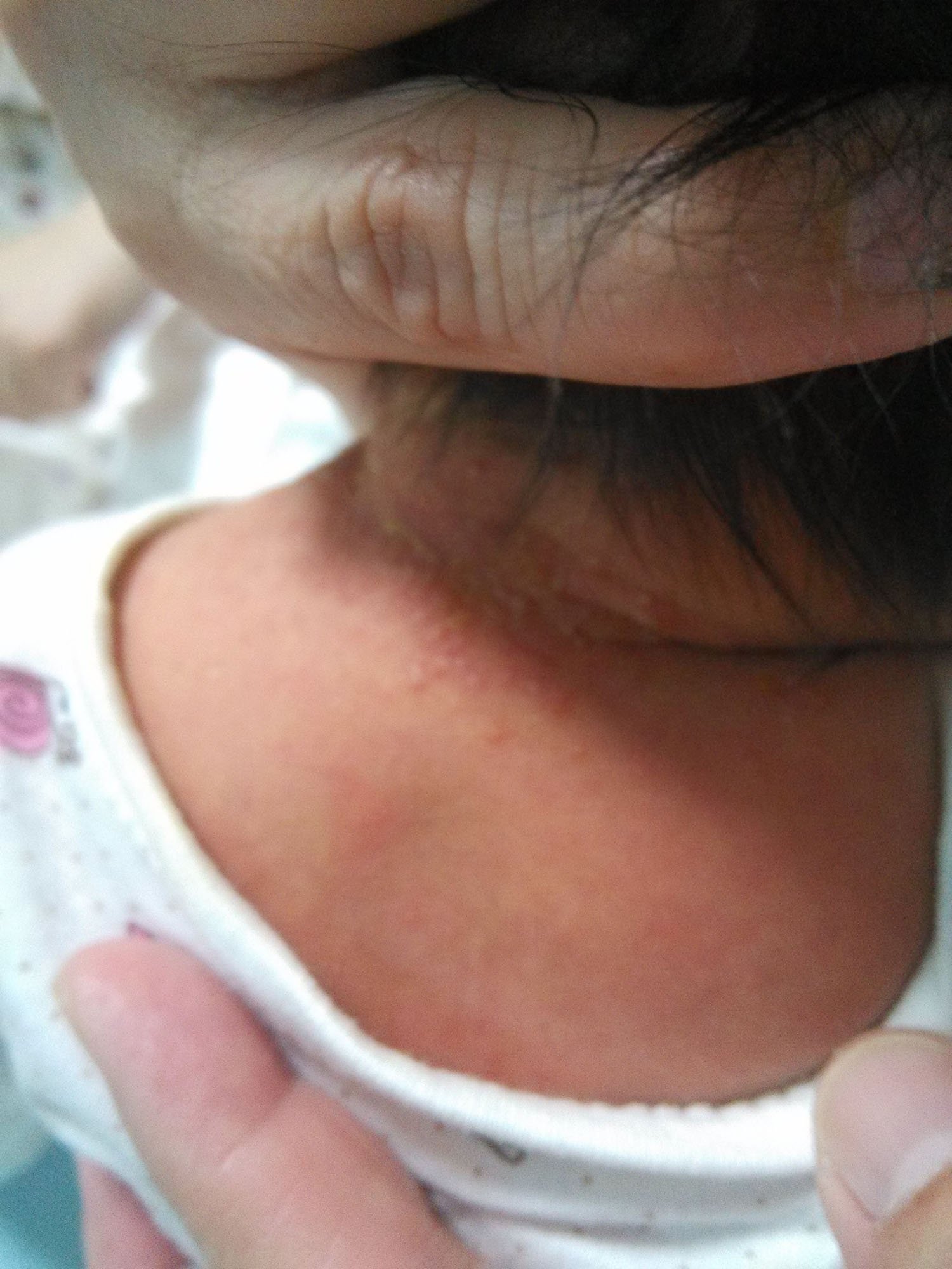 婴儿脖子上出现疹子,14年6月5日出生的婴儿女孩,脖子上出现了这些疹子