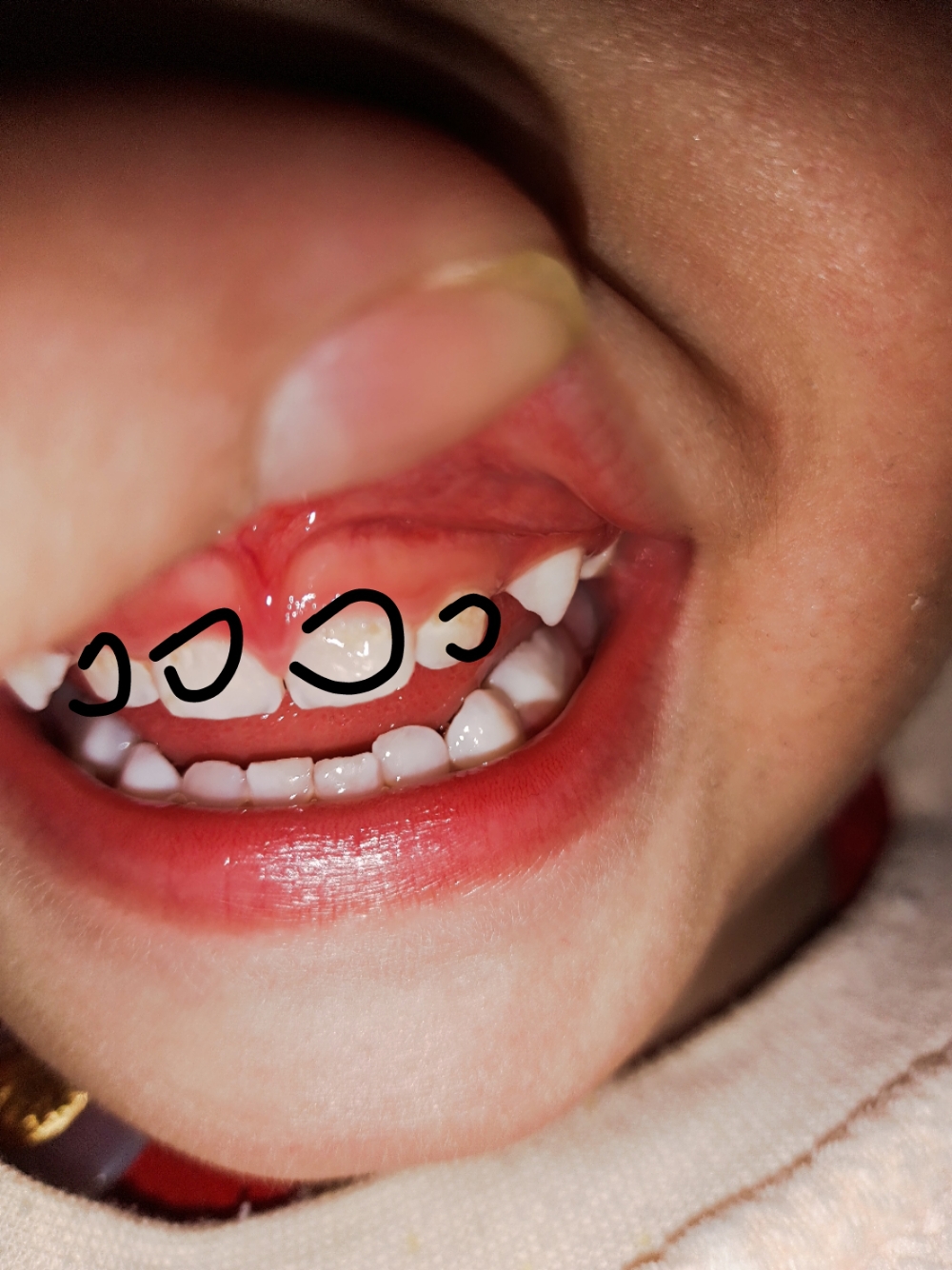 两岁宝宝牙齿坏了怎么办