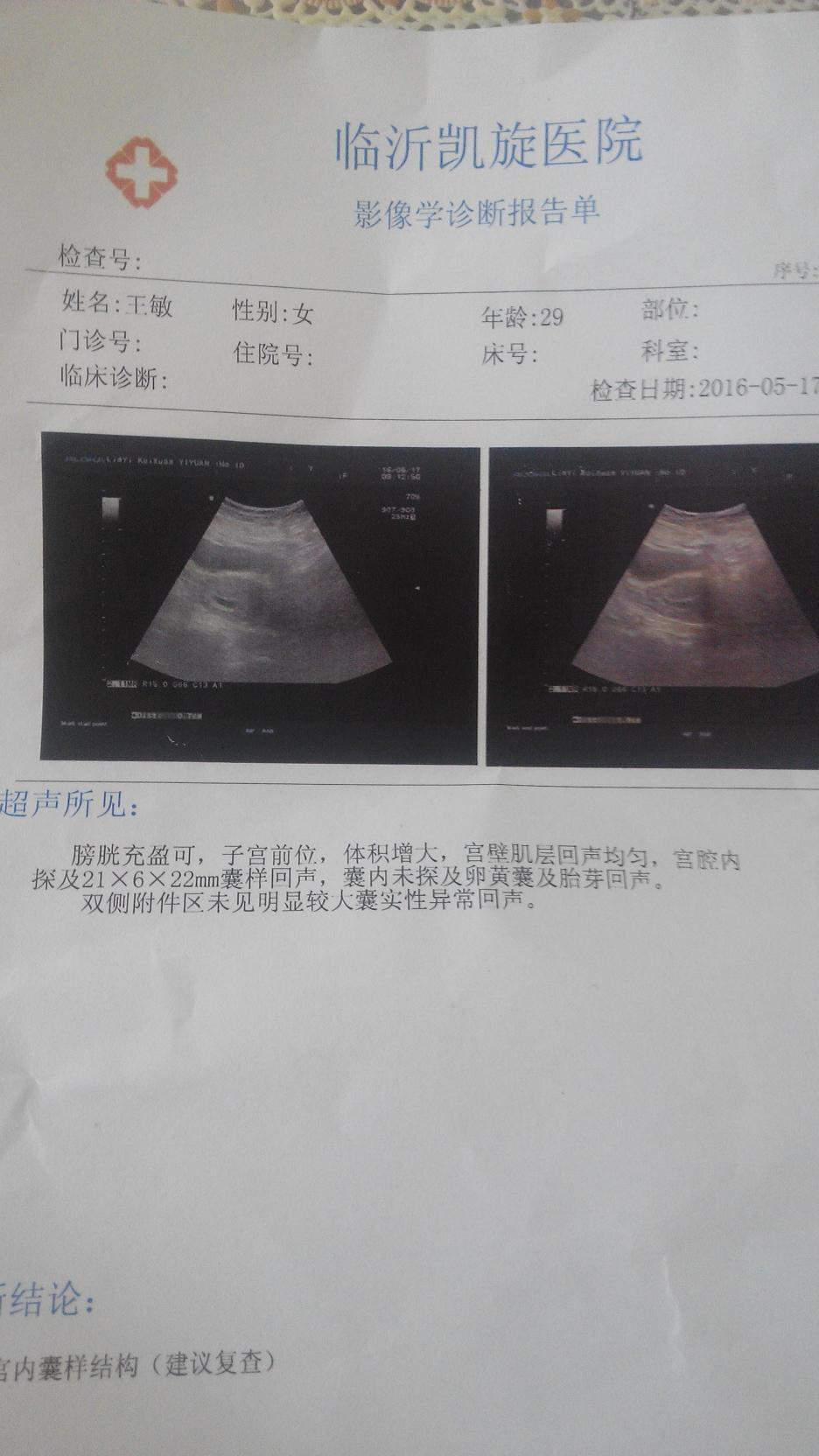 怀孕40天了今天去医院检查看见孕囊了是宫内孕因太小还没看见胎心胎芽