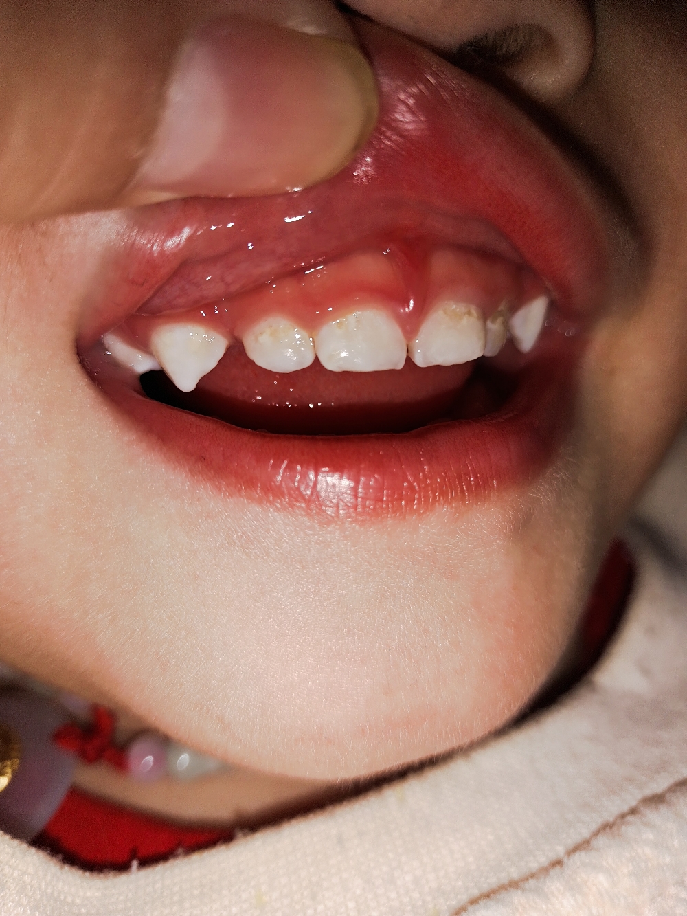 两岁宝宝牙齿坏了怎么办