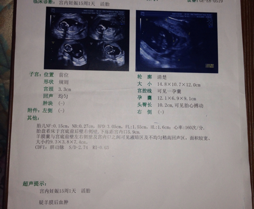 怀孕17周羊膜囊与宫底前壁左右侧及宫口之间面积较宽大小9.3*3.