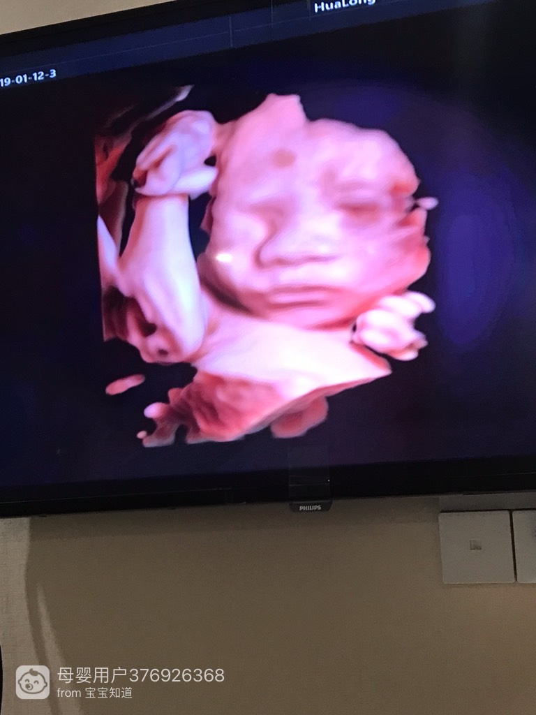 4维彩超宝宝鼻子又大又扁又宽,好担心,生下来会是和4维一样吗?