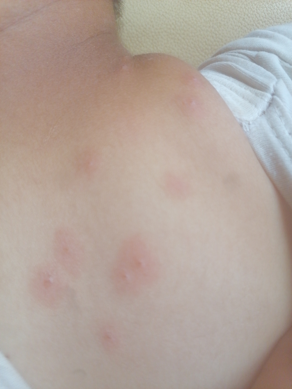 一岁九个月宝宝身上起红疹子很痒脸上有三个,背部脖子胳膊腋下都有