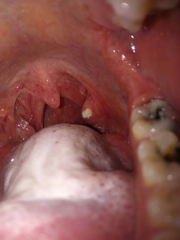 孕妇喉咙长了这个白色的疙瘩,这是什么?怎么引起的?怎么治疗呢?