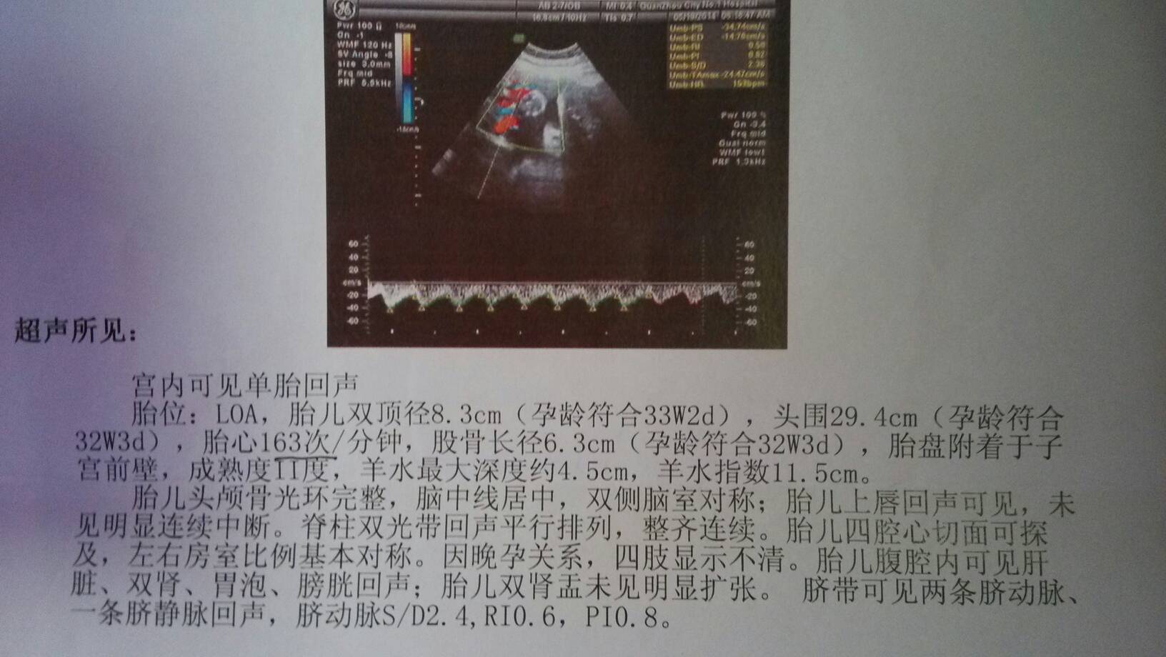 其他回答 病情分析: 你好,根据彩超结果看,胎儿胎位正,孕32周左右