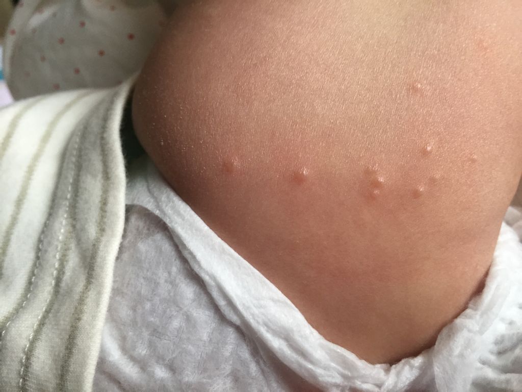 宝宝4个月了,今天早上给他换尿不湿的时候看到腿上长了几个小痘痘,还