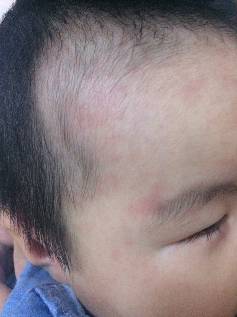 宝宝脸上起这红疹是什么原因?