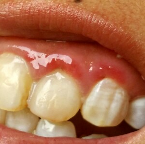 孕妇期间牙龈红红的,刷牙总是出血!这是什么原因?有什么办法治好?