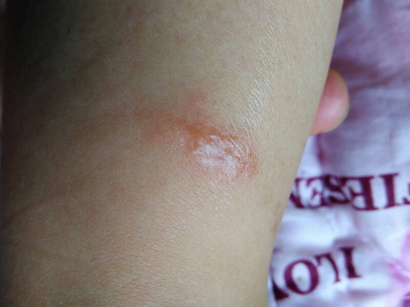 其他回答 这个是丘疹性荨麻疹,多是蚊虫螨虫叮咬等等引起的皮肤过敏