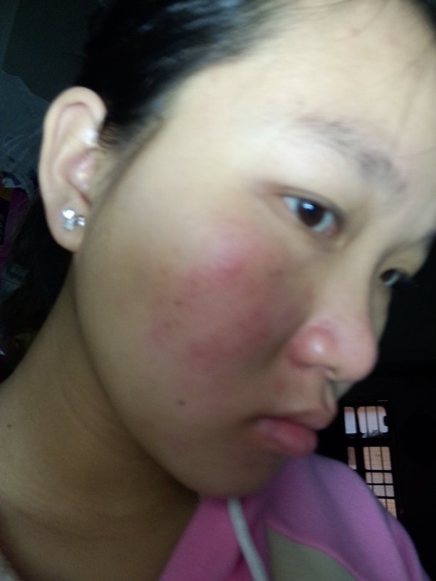 季节性接触皮肤过敏面部孕妇能用芦荟胶吗?每次冷空气都会过敏