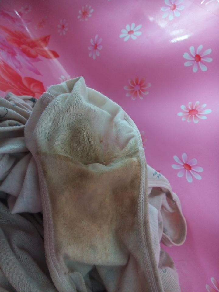 是黄色的分泌物有和我一样的吗?