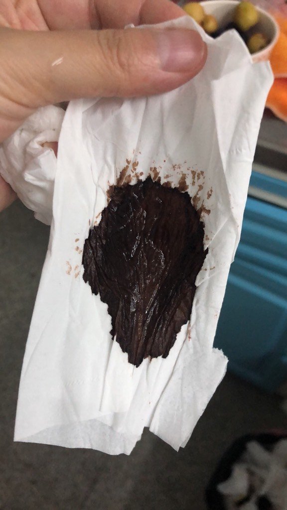 4楼 我住院半个月了,nt也过了,每天打针保胎,还是流黑血