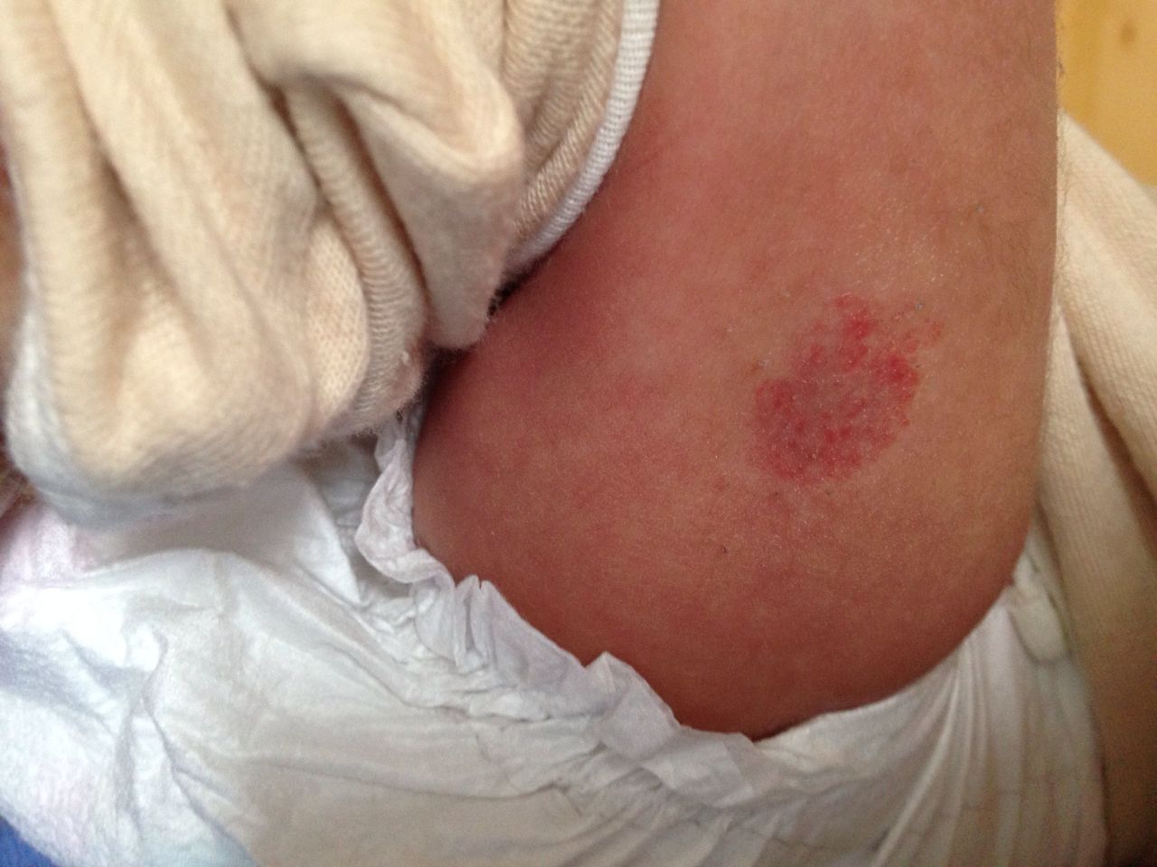 出生12天的宝宝大腿上长了一块红点,请问这是什么病?怎么治疗?