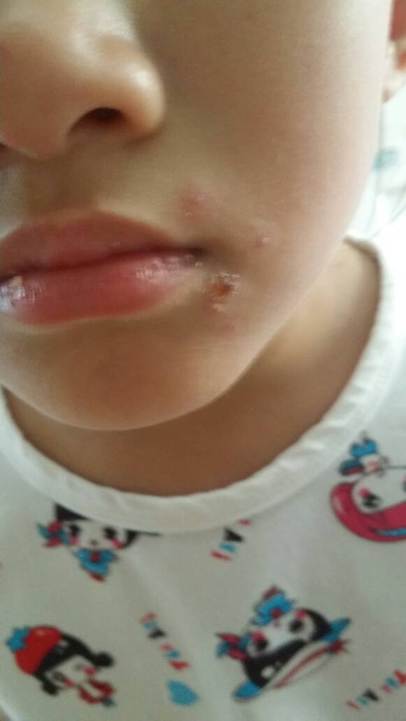 小孩7周岁,嘴角长这个红点是什么?