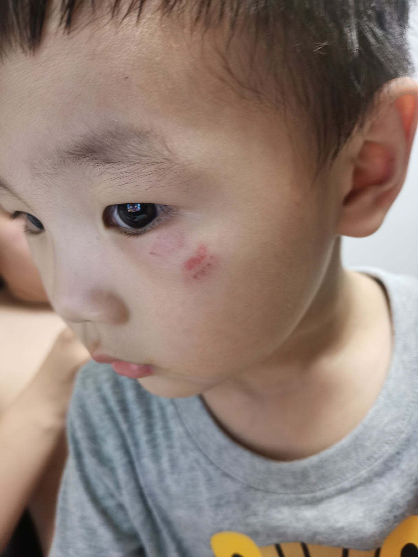 小孩在幼儿园被其他小朋友咬了一口在眼睛下面