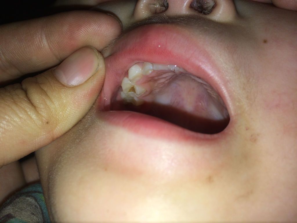 孩子的牙怎么了?