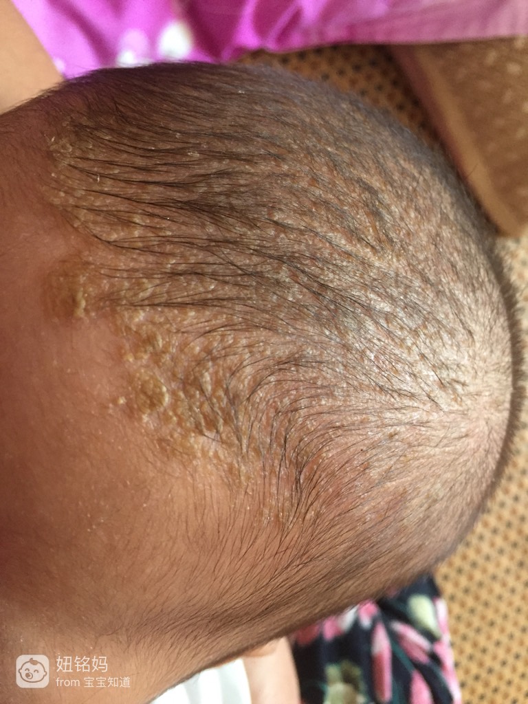 六个月宝宝头皮黄痂图图片