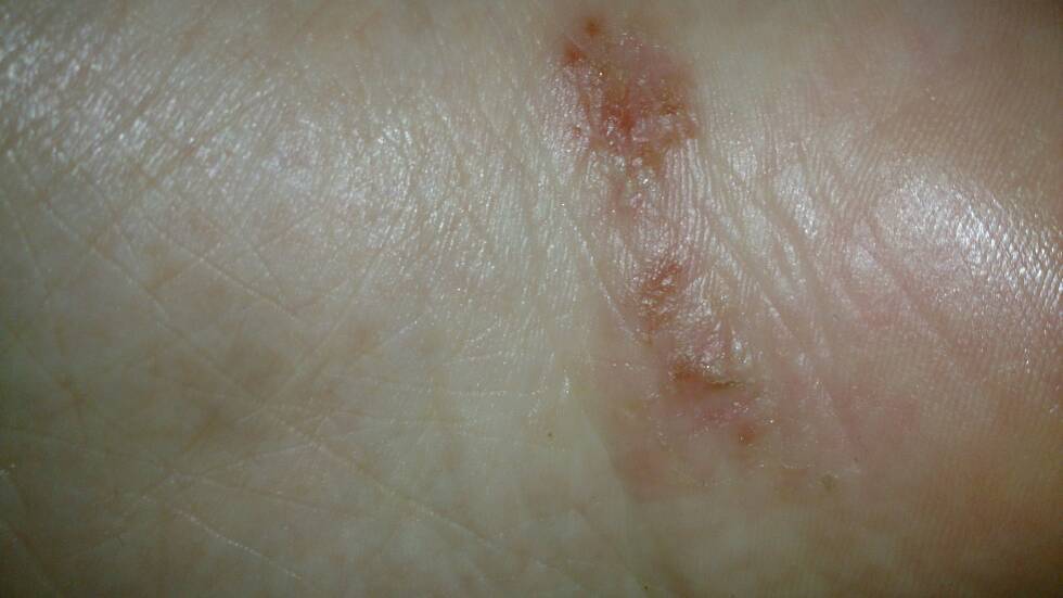 怎么治?又痒又疼!还有流黄水!