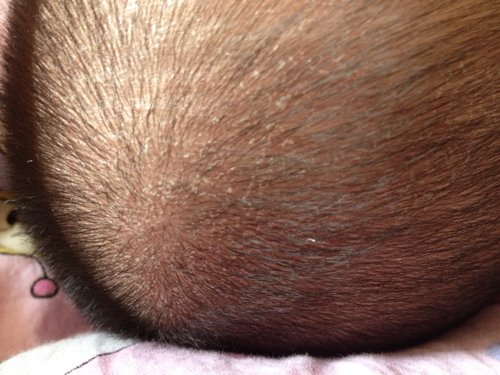 大家看看这是湿疹吗?宝宝头上起了红色点点还起皮!怎么办啊?