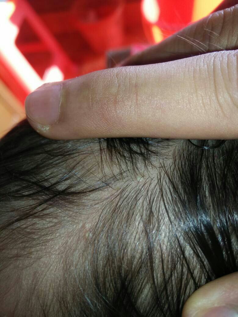 宝宝头上长一个个黄色的像脓包一样的东西是什么怎么办