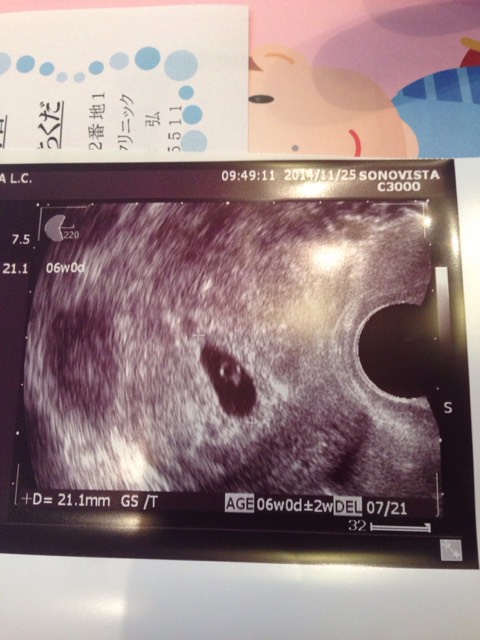 怀孕42天彩超单图片图片