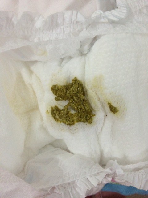 宝宝黄疸超标怎么办拉的粑粑这颜色正常吗