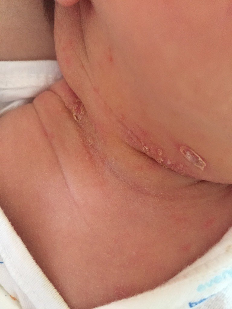 这些是痱子还是湿疹?