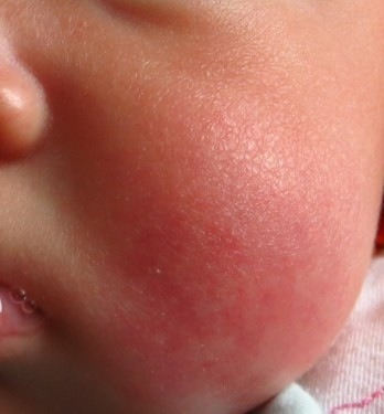 宝宝的脸最近变的红红的还变的皮肤很粗糙,请问是湿疹吗