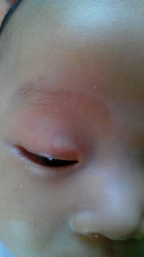 婴儿眼皮上红血丝图片图片