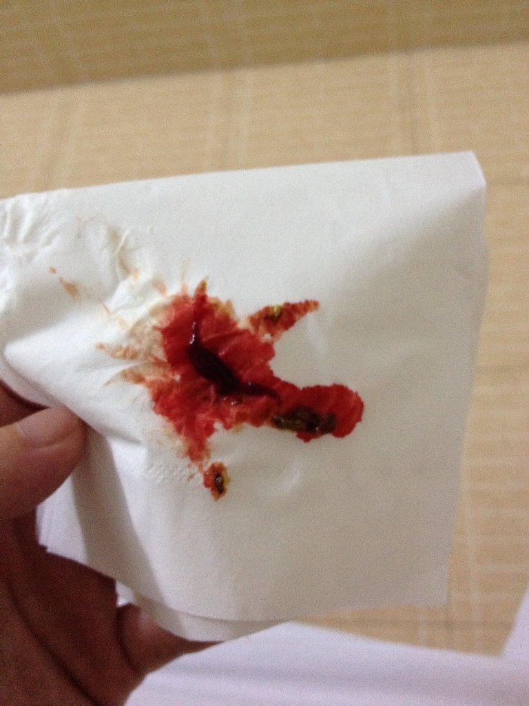 躺着腰很酸 老想大便可是又拉不出来 今天大便后擦出来果冻一样的东西