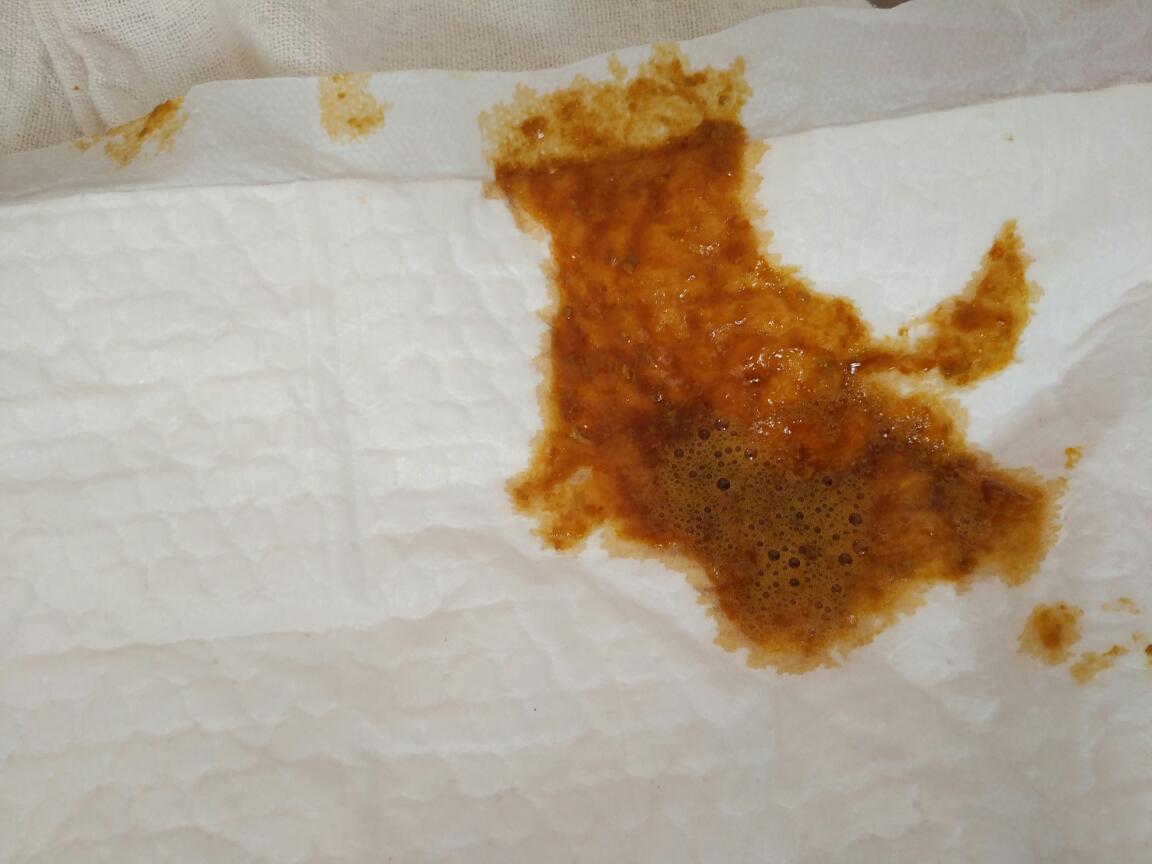 宝宝出11天拉的粑粑呈泡沫状,肚子有时候还咕噜咕噜的响,请问是怎么