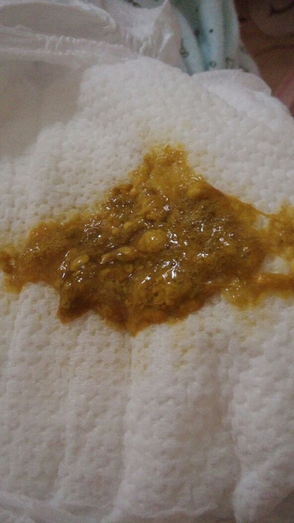宝宝79天了,今天便便反常,出现类似蛋清状的东西 求助