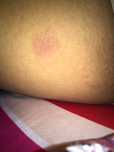 大腿内侧突然起来一推疙瘩，.怎么回事啊？现在哺乳期没出去洗澡过 按时换洗衣服…这怎么了…三天了