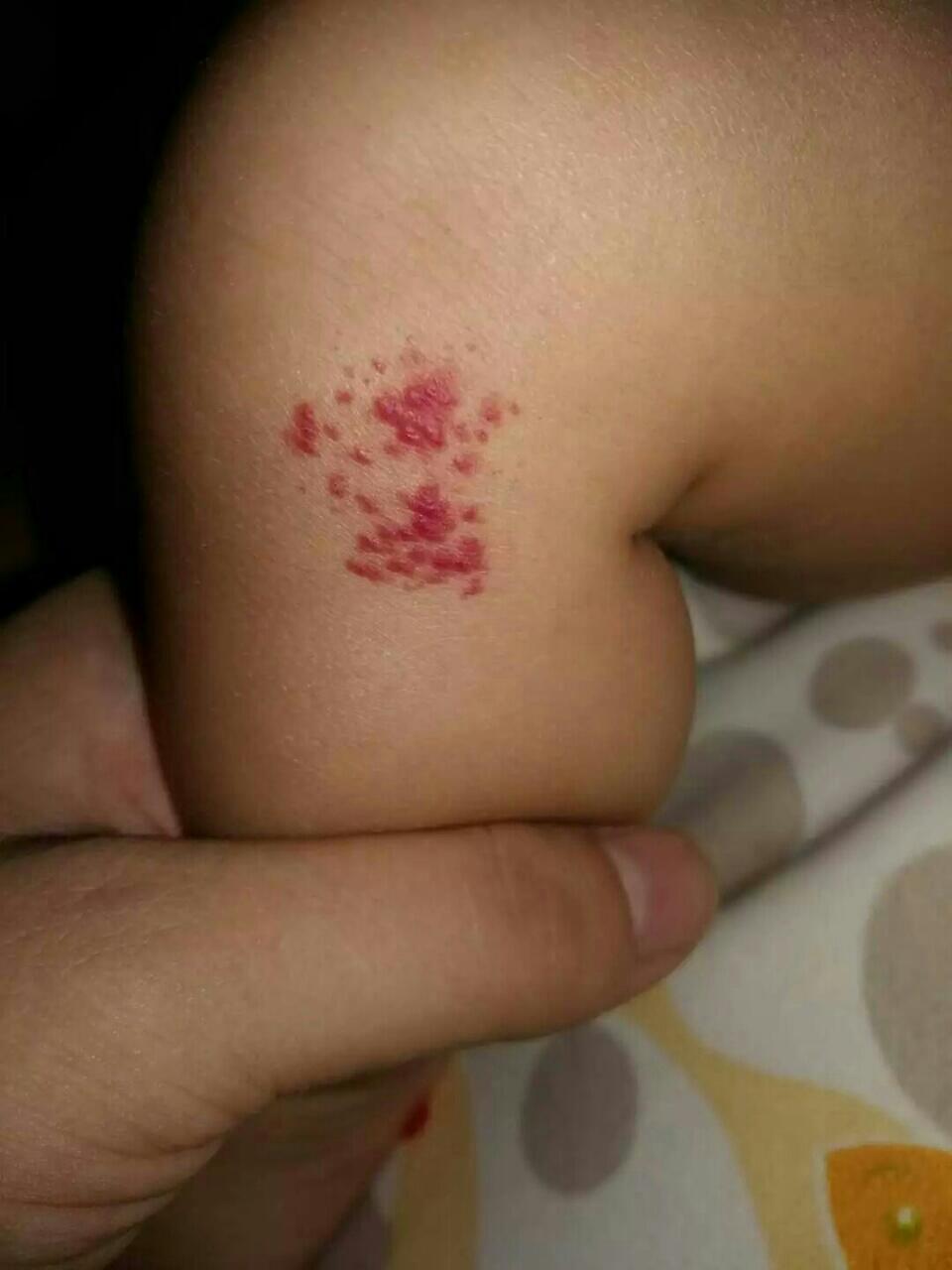 宝宝身上若是有红色胎记,当心是血管瘤