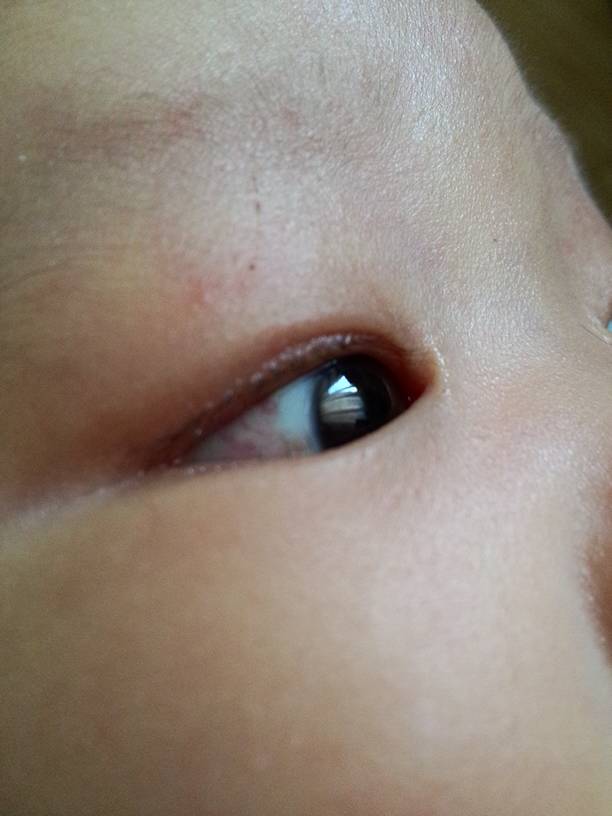新生儿眼珠有血杠图片图片
