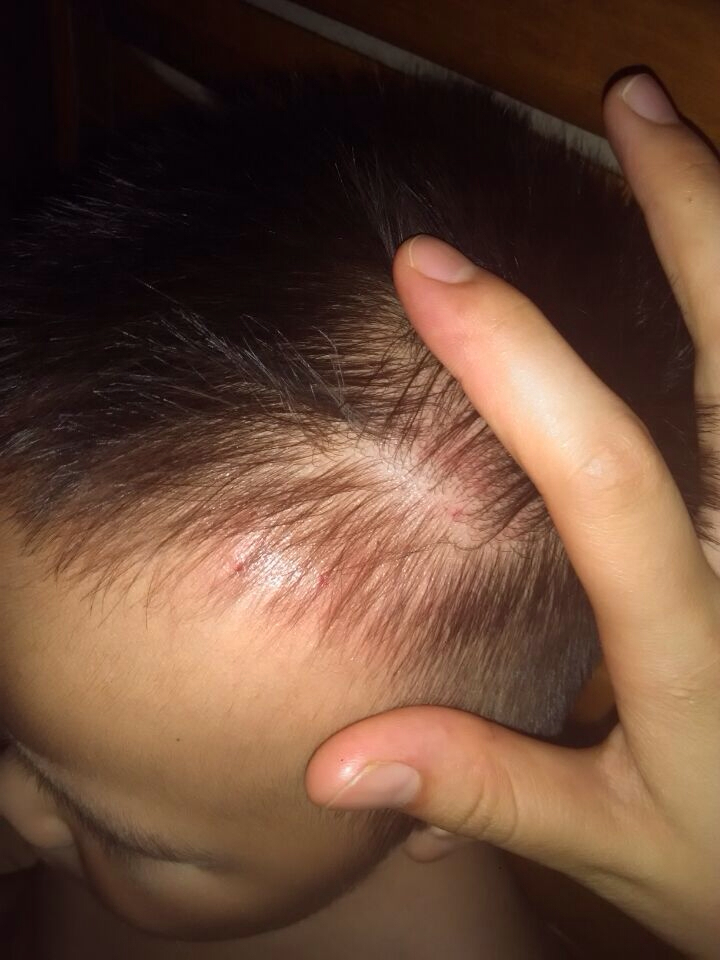 一岁半的小宝宝从一米的高空摔下来,头部这个摔的比较严重,但是不知道