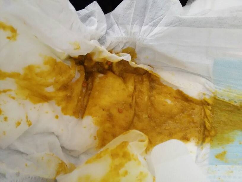 这种大便正常吗?好稀的