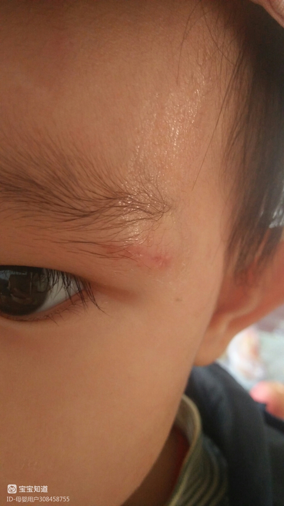 一岁半宝宝摔跤眼皮破口流血不缝针以后会留疤痕吗