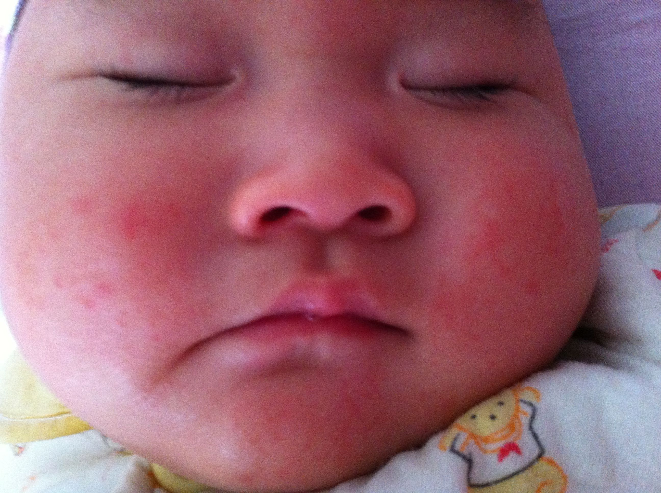 热疹图片初期症状图片 婴儿热疹症状（崔玉涛问答：宝宝身上起了这种小红点该怎么办？） | 说明书网
