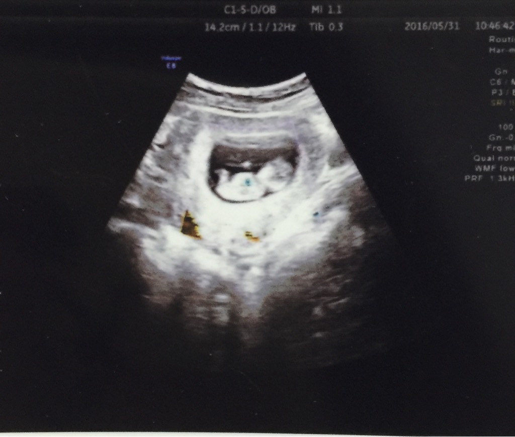 孕14周胎儿图片图片