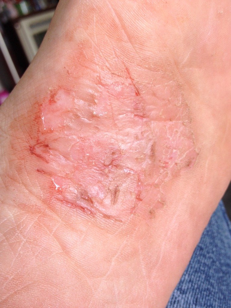 从生了宝宝以后,我的左脚脚底就开始很痒,然后就抓